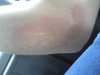 2012_08_25 Pez got burned on a GoKart.jpg 2012_08_25 Pez got burned on a GoKart.jpg